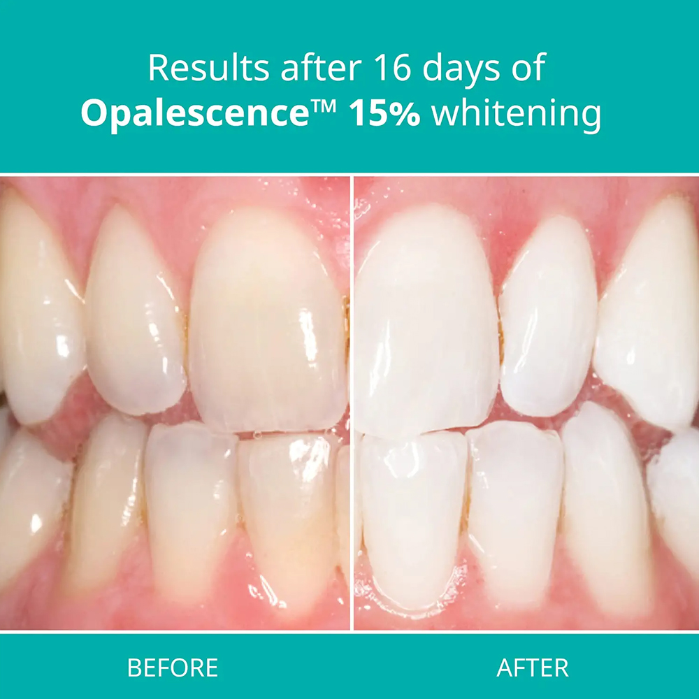 Teeth Whitening Gel Home Kit D - Teeth Whitening Gel Opalescence recensie en prijs