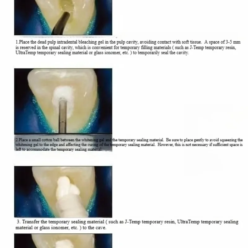 Dental Oral Restoration Materi - Teeth Whitening Effects recensie en prijs