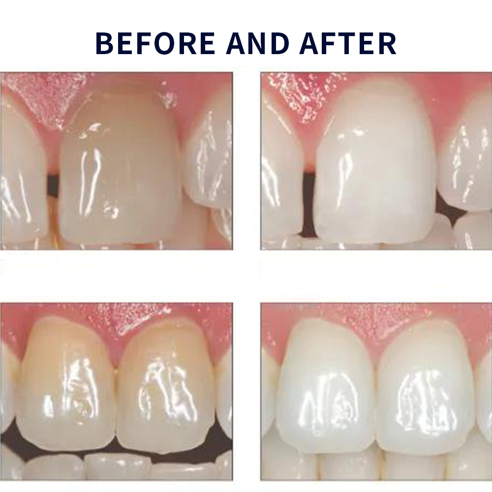 Opalescence Whitening 20% PF 2 - Teeth Whitening Gel Opalescence recensie en prijs