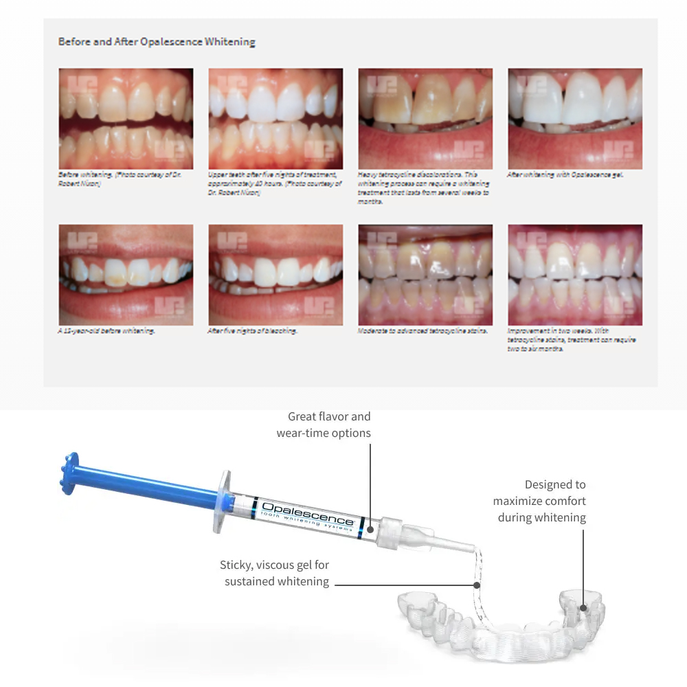 Opalescence Whitening 20% PF 2 - Teeth Whitening Gel Opalescence recensie en prijs