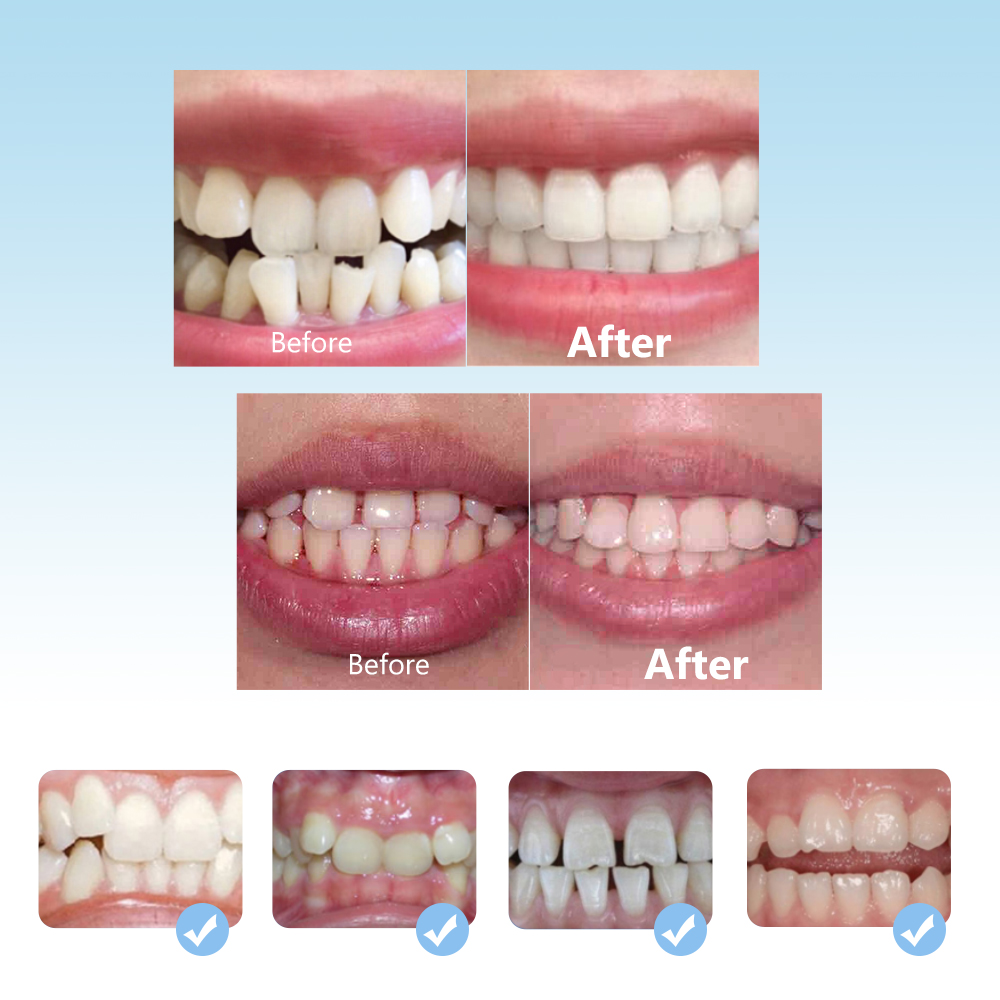 Dental Orthodontic Braces Set  - Teeth Whitening With Braces recensie en prijs