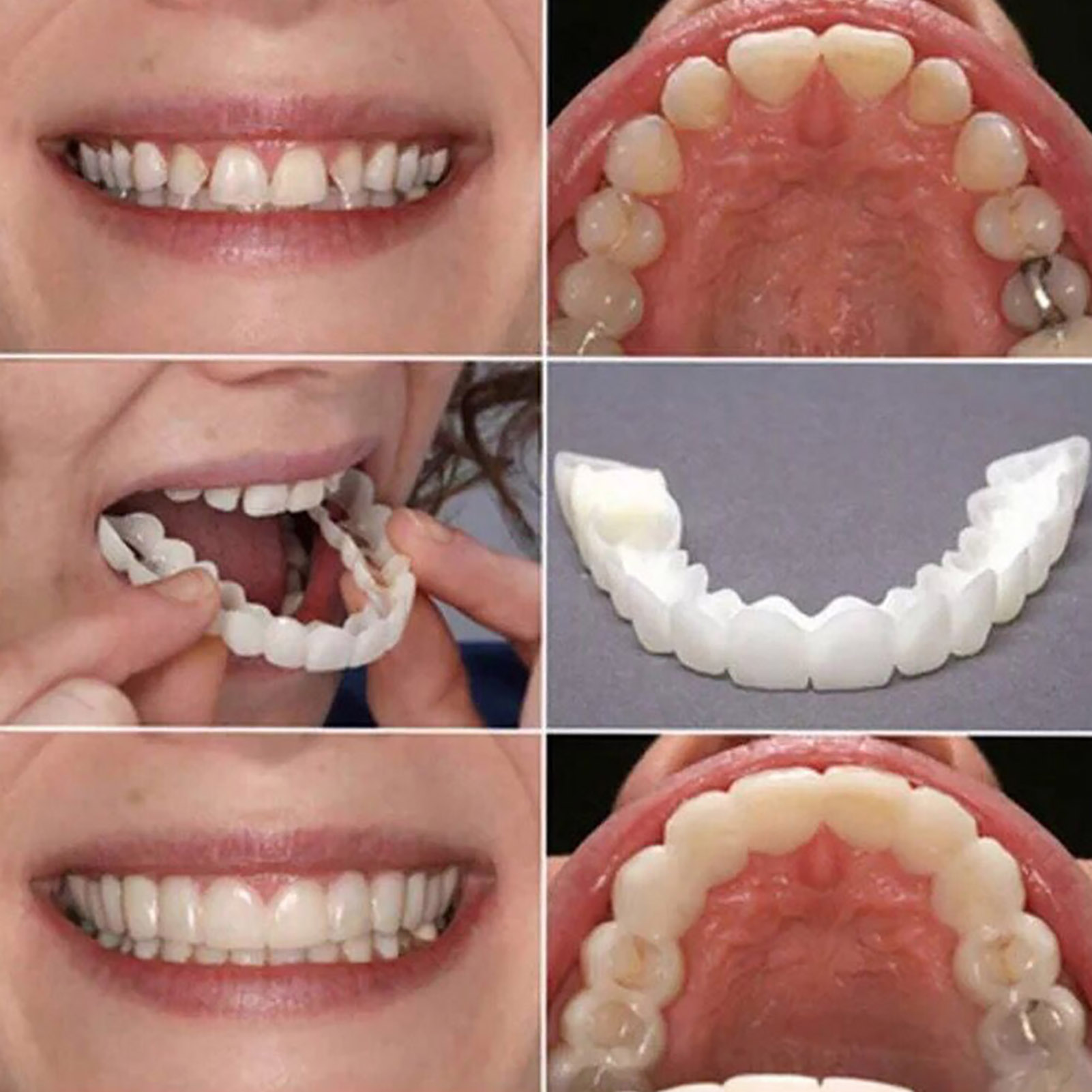 Hot Teeth Veneers Whitening De - Teeth Whitening With Braces recensie en prijs