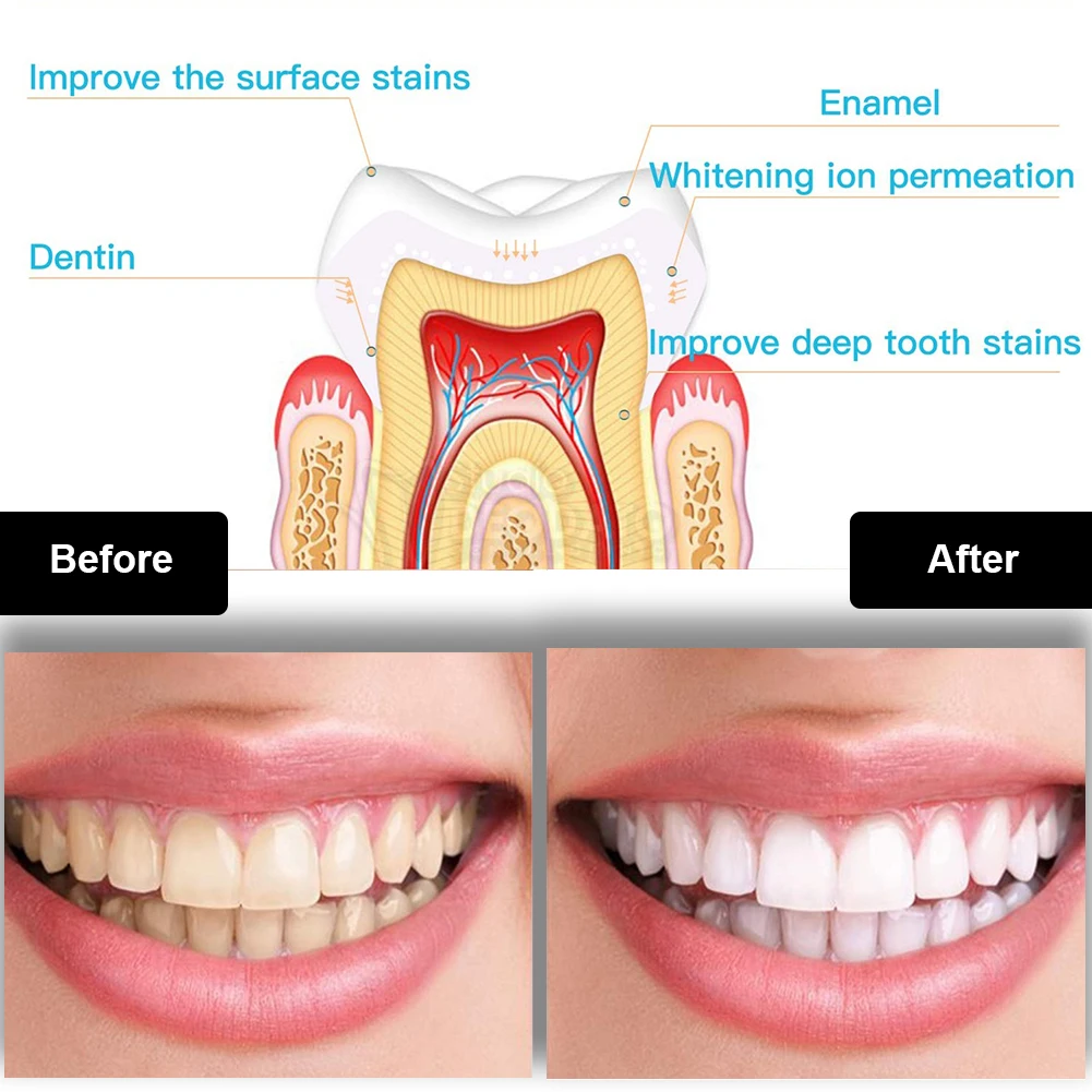 Dental Teeth Whitening Kit Min - Teeth Whitening Clinic recensie en prijs