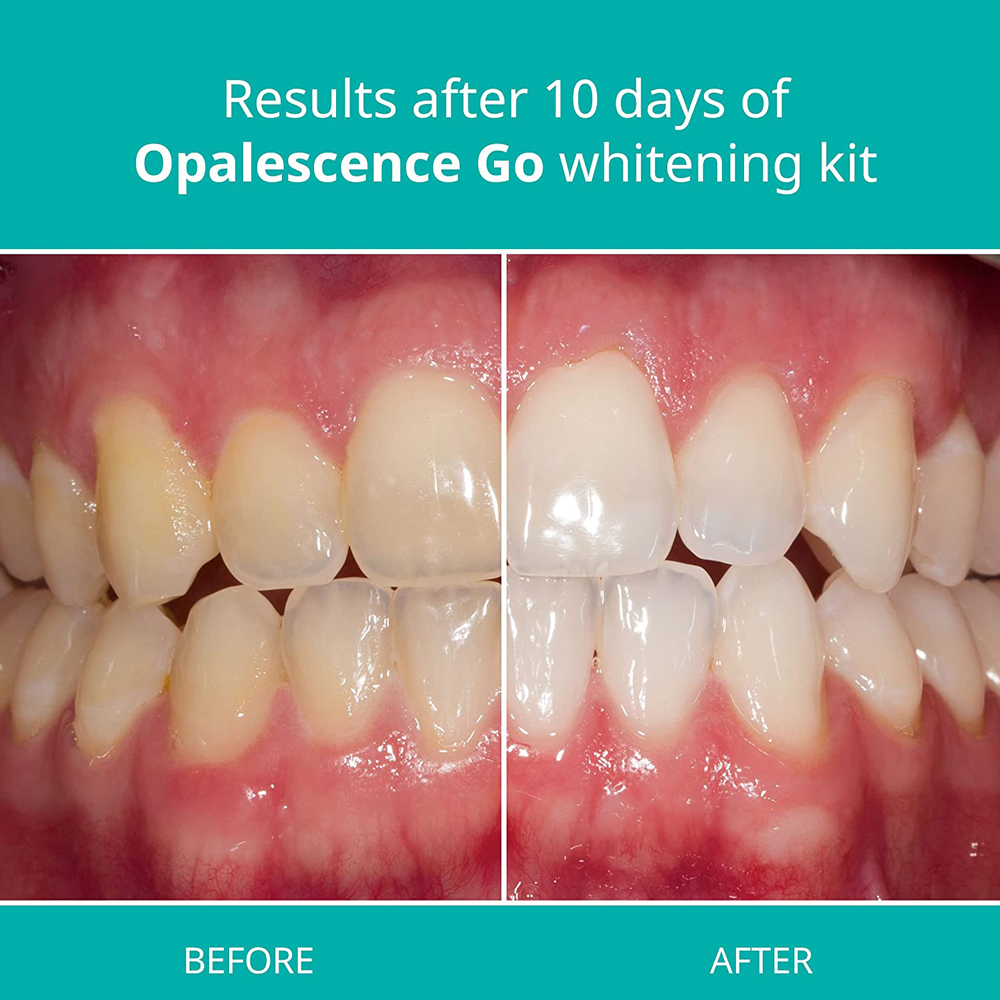 Opalescence Go Teeth Whitening - Teeth Whitening Gel Opalescence recensie en prijs