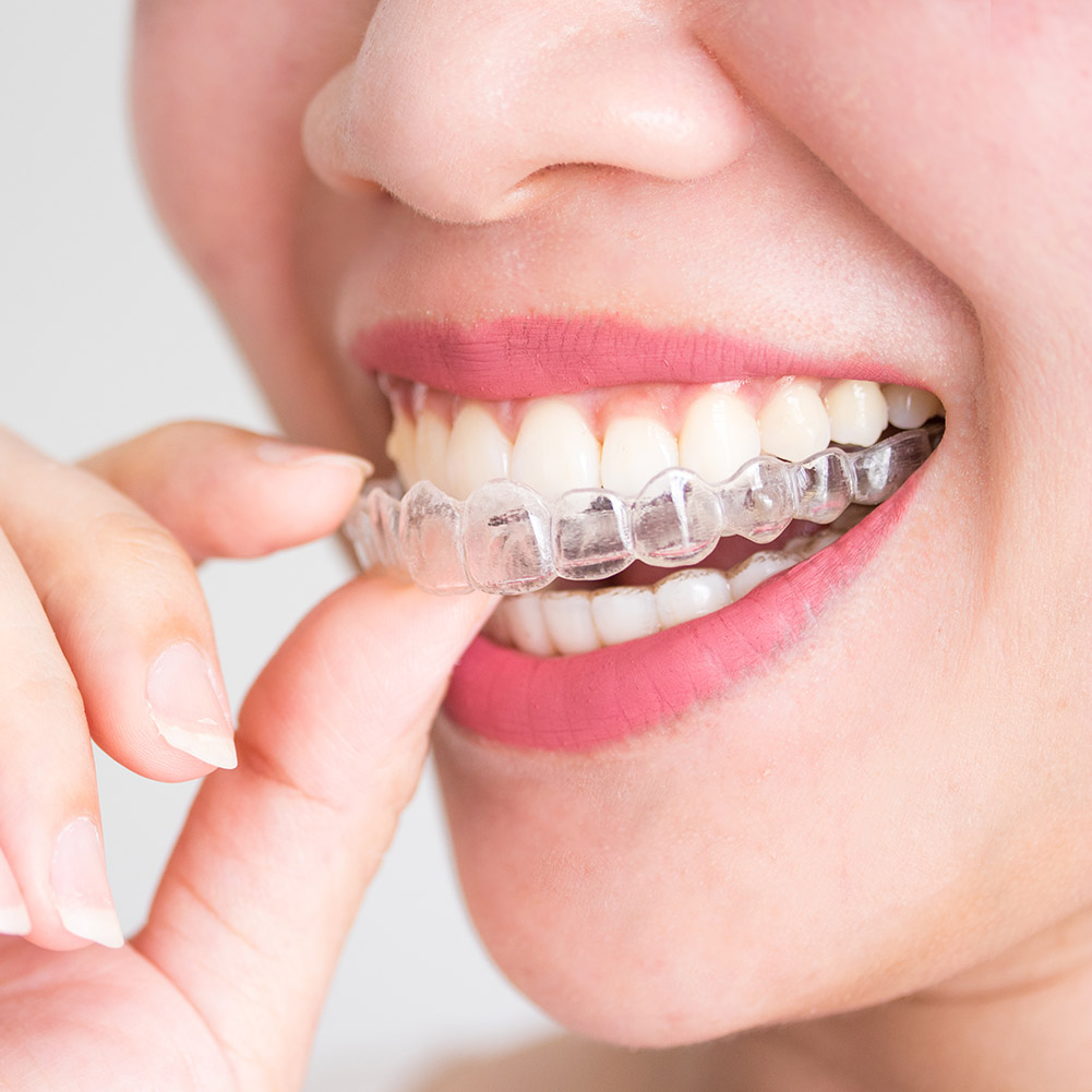 2/4pcs Mouth Guard Teeth Prote - Teeth Whitening With Braces recensie en prijs