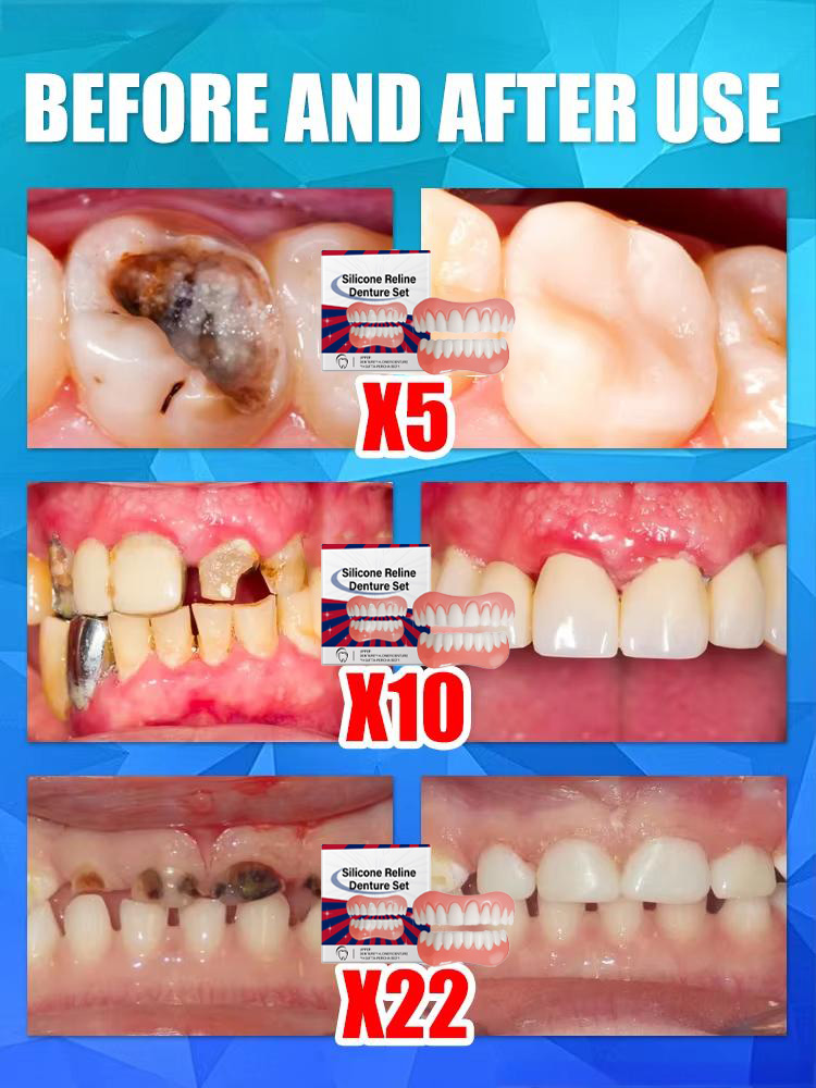 False Teeth Silicone Upper Low - Teeth Whitening With Braces recensie en prijs
